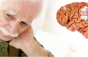 Во САД одобрен лек за Алцхајмеровата болест