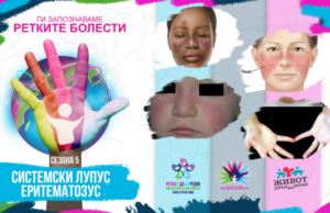 Ги запознаваме ретките болести: Системски лупус еритематозус