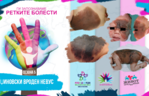 Ги запознаваме ретките болести: Џиновски вроден невус