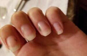 Лицата со малигни заболувања се соочуваат со континуиран недостиг на терапија