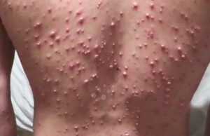 Младо момче со овчи сипаници примено на Интензивна, бил во контакт со бебиња и критично болни