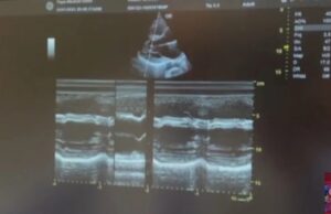 Кај 29-годишен Албанец срцето и другите органи се на спротивната страна