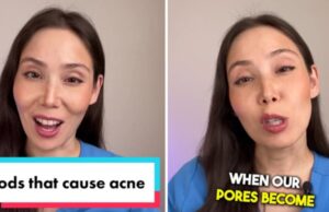 Дерматолог: Оваа храна може да предизвика акни и други проблеми со кожата на лицето