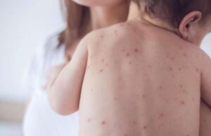 Тринаесетмесечното дете заразено со морбили е пуштено на домашно лекување