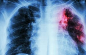 Туберкулозата е најзаразна болест на светот