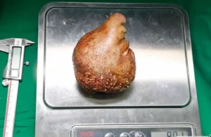 Гинисов рекорд: Изваден најголемиот камен во бубрег во светот