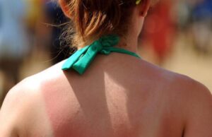 Состојки што ги имате по дома а може да помогнат против изгореници