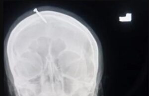 Виенските научници развија нови маркери за рана дијагноза на мултиплекс склероза