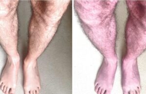 Ако имате сини нозе сигурно боледувате од постковид синдром