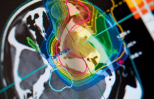 Создаден првиот акцелератор за лекување рак со јонска терапија