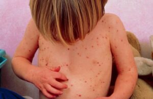 Смртноста од сипаниците морбили зголемена за 40 отсто во светот поради мал број вакцинирани