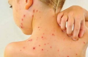 Романија прогласи епидемија на мали сипаници