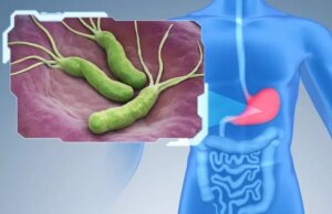 Две третини од луѓето во светот имаат „хеликобактер пилори“ и тоа значи поголема опасност од Алцхајмерова болест