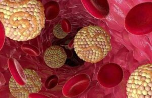 Се подготвува вакцина за висок холестерол