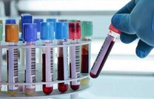 Откриен нов, прецизен метод преку анализа на крвта за дијагностицирање на Алцхајмерова болест