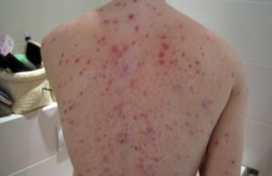 Поради зголемениот број на случаи со морбили, отворени два пункта за вакцинација во Сараево