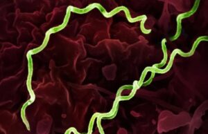 Зголемен бројот на заразени со сифилис во САД