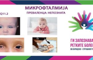Ги запознаваме ретките болести во охридско-струшкиот регион: Микрофталмија