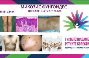 Ги запознаваме ретките болести во охридско-струшкиот регион: Mикозис фунгоидес