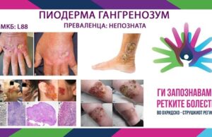 Ги запознаваме ретките болести во охридско-струшкиот регион: Гангренозна пиодермија