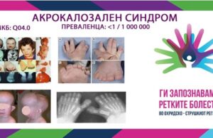 Ги запознаваме ретките болести во охридско – струшкиот регион: Акрокалозален синдром
