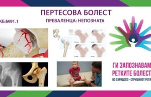 Ги запознаваме ретките болести во охридско-струшкиот регион: Пертесова болест