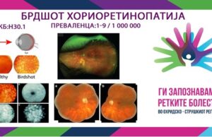 Ги запознаваме ретките болести во охридско – струшкиот регион: Бирдшот хориоретинопатија