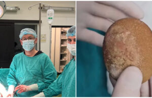 На Kлиниката за урологија изваден најголемиот камен од мочен меур во последните 20 години