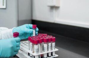 Луѓето со одредени крвни групи полесно се справуваат од маснотиите