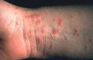 Зголемен е бројот на заболени со овчи сипаници, пријавени се 825 случаи, има и случаи на шуга и заушки