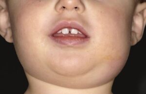 Хоспитализирани две лица со конго-кримска хеморагична треска во април, две деца имале заушки