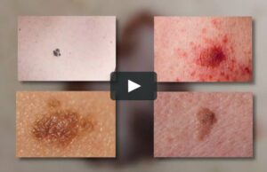 Чести самопрегледи и заштита од сонце, советуваат дерматолозите за заштита од меланом