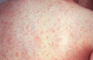 Во Белград регистрирани вкупно 72 случаи на мали сипаници