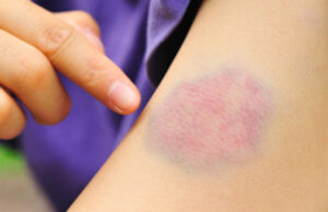 Кои здравствени проблеми можат да бидат причина за модринки по телото?