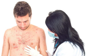 551 лице со овчи сипаници во јуни, пад во однос на заболени во мај