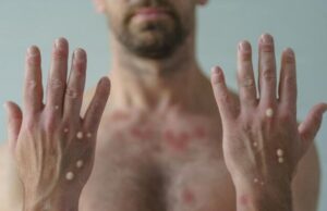 Светската здравствена организација одржува итен состанок-се појави нов сој мајмунски сипаници