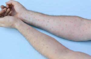 Лекот против мпокс не е ефикасен, вирусот брзо се шири