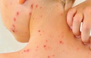 Подгорица и Будва прогласија епидемија на морбили