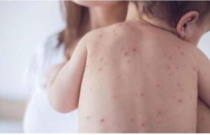 Ставриќ: По случајот со морбили во Долно Коњаре, во тамошните училишта е можна теренска кампања за вакцинација