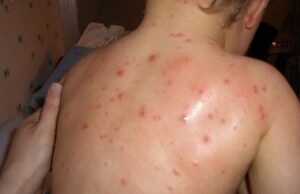 Втор случај на мали сипаници, заразено е 12-годишно дете од Долно Коњаре кое бе било вакцинирано