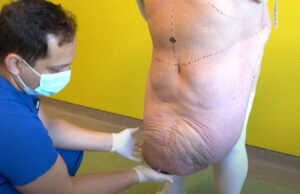 (Видео) Тумор од 35 килограми отстранет од пациент во скопска приватна клиника