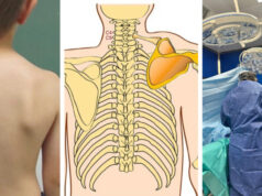 За првпат во РС Македонија е изведена хируршка интервенција кај дете со ретка конгенитална деформација