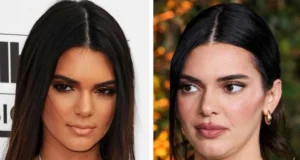 Кендал Џенер ги демантира гласините за операција: „Носот ми се промени од лекови против акни“